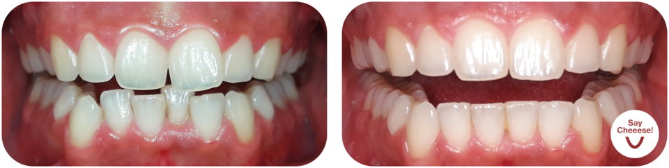 Before/after: crowding treated with invisible aligners from Vienna
