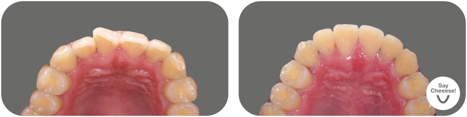 Before/after image of straightened front teeth