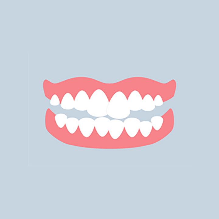 Illustration: crowding of teeth in upper and lower jaw