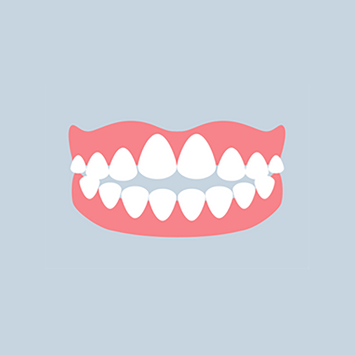 Illustration: open bite — front teeth don't touch when biting down