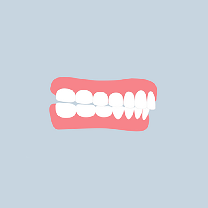 Illustration: underbite — upper front teeth overlap the lower ones