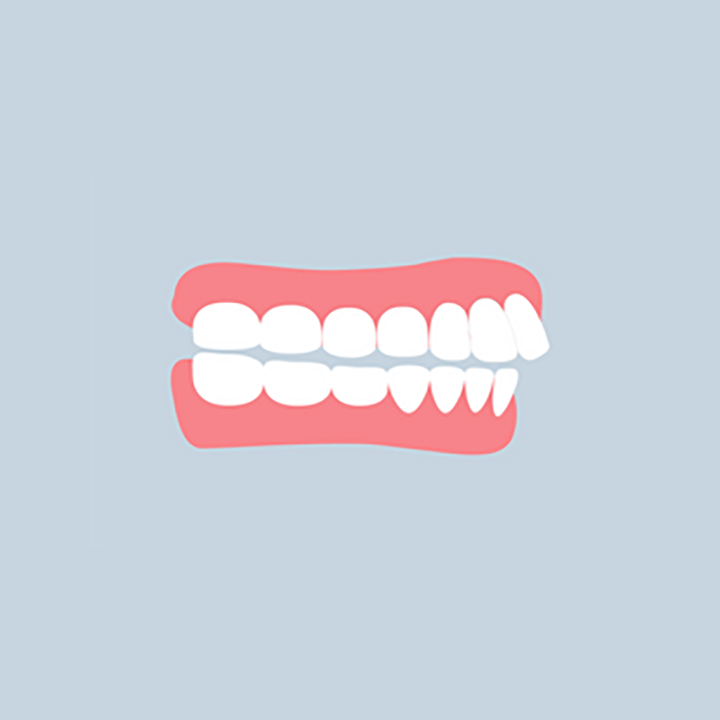Illustration: overbite of the upper front teeth