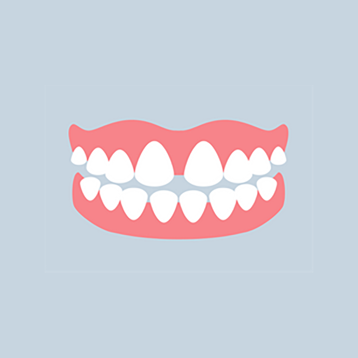 Illustration: gap between the upper front teeth