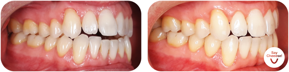 Before/after open bite with invisible aligners Vienna