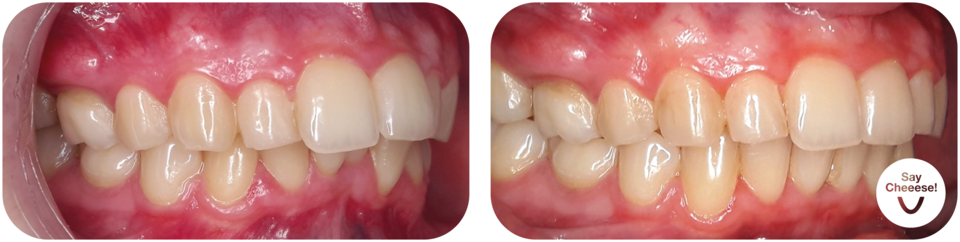 Before/after underbite with invisible aligners Vienna