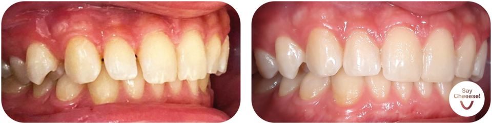 Before/after underbite Vienna aligners