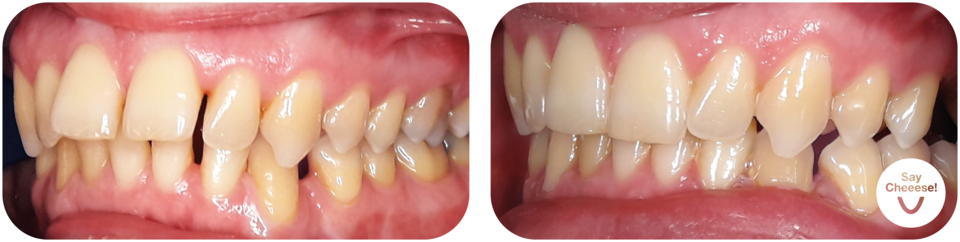 Before/after overbite of the front teeth with invisible aligners Vienna