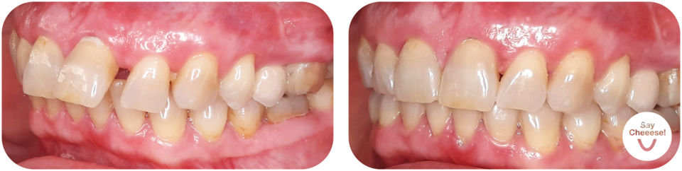 Before/after overbite Vienna aligners