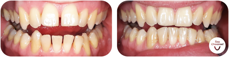Before/after gap with invisible aligners Vienna
