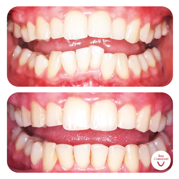 Engstand · Vorher / Nachher