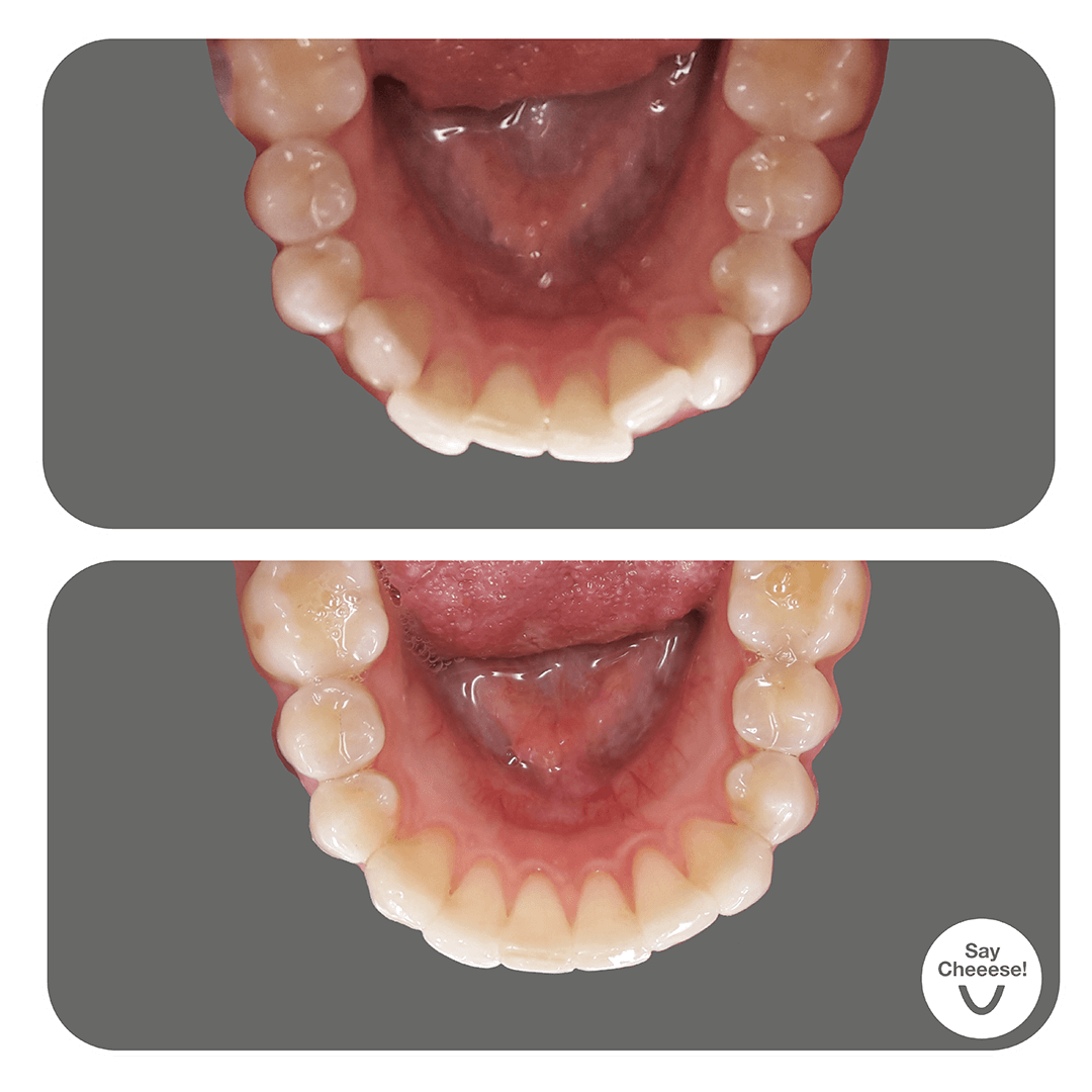 Vorher / Nachher mit SayCheeese Zahnschiene
