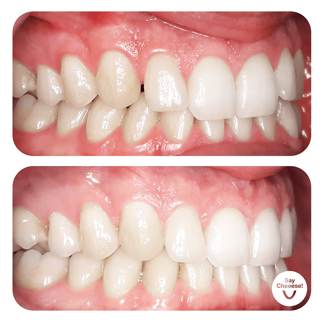 Zahnlücken & Engstand · Vorher / Nachher
