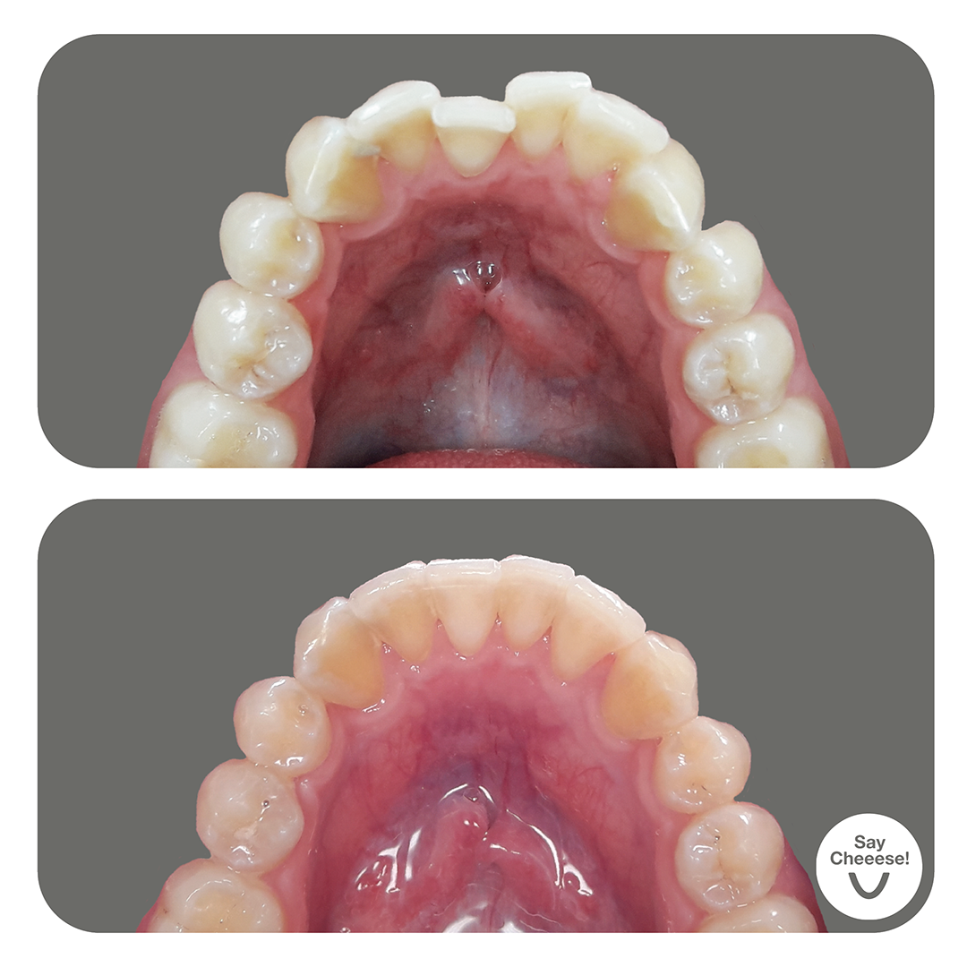 Engstand · Vorher / Nachher